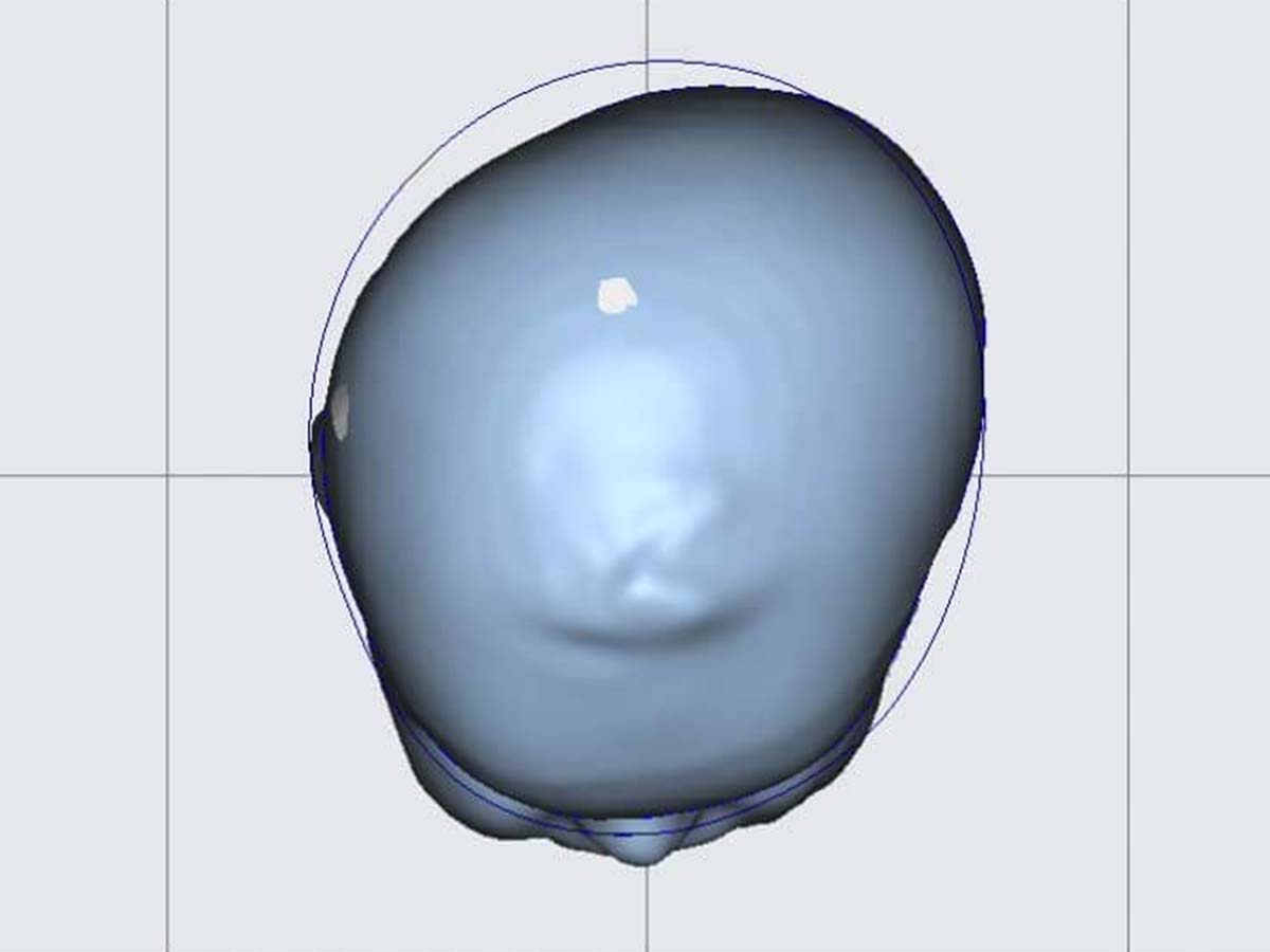 Visualisation 3D du crâne d'un patient en plagiocéphalie